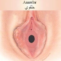 پرده بكارت حلقوي