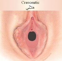 پرده بكارت هلالي