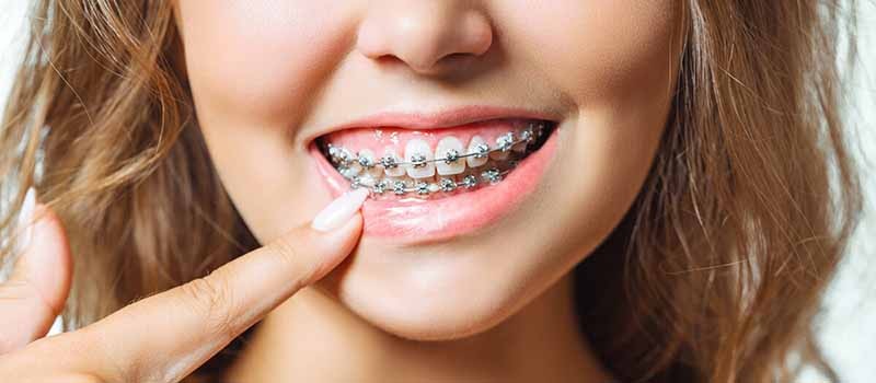 بررسی مهم ترین نکات ارتودنسی دندان و انواع آن